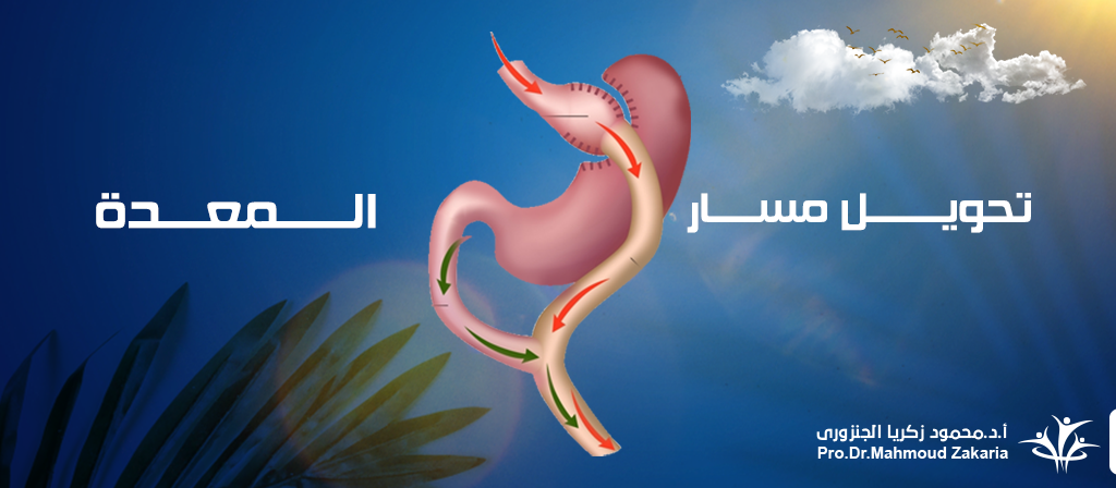 عملية تحويل المسار بالمنظار (النظام الغذائى) 2020