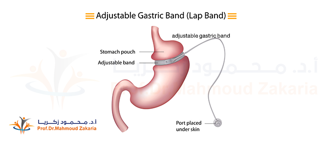 Gastric Band Surgery Cost (Gastric Band)